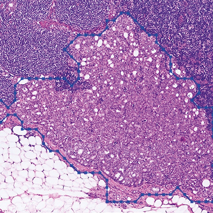 CUHK AI-assisted Cancer Diagnosis