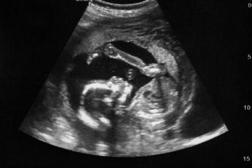 An ultrasound image of a foetus