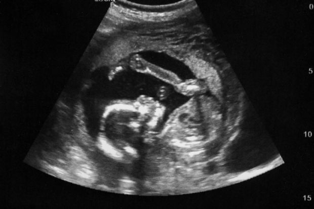 An ultrasound image of a foetus